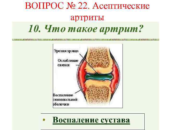 ВОПРОС № 22. Асептические артриты 
