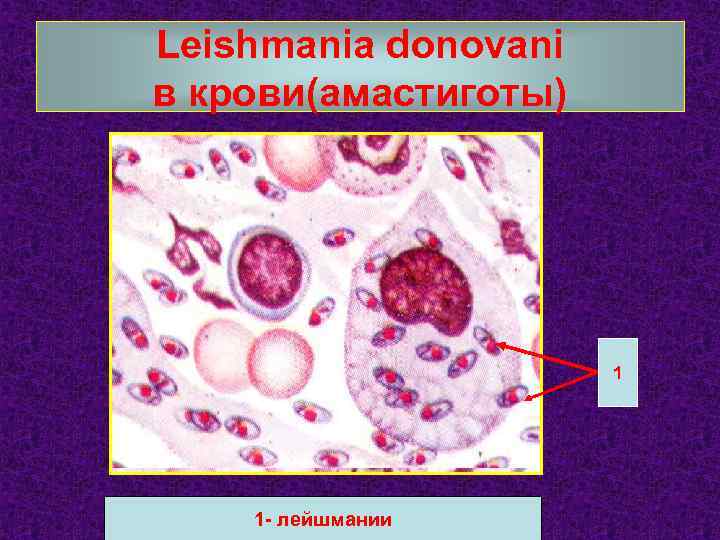 Leishmania donovani в крови(амастиготы) 1 1 - лейшмании 