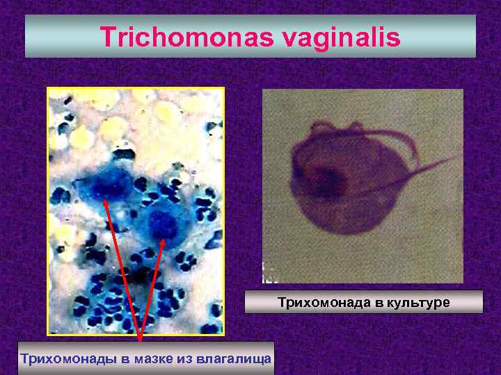 Trichomonas vaginalis Трихомонада в культуре Трихомонады в мазке из влагалища 