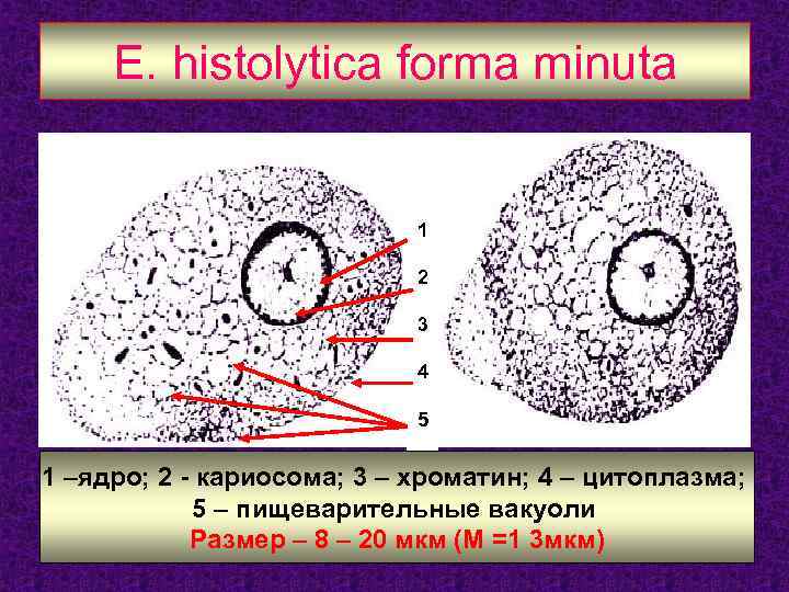 E. histolytica forma minuta 1 2 3 4 5 1 –ядро; 2 - кариосома;