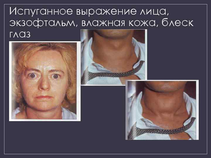 Испуганное выражение лица, экзофтальм, влажная кожа, блеск глаз 