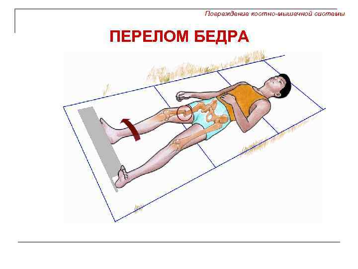Повреждение костно-мышечной системы ПЕРЕЛОМ БЕДРА 
