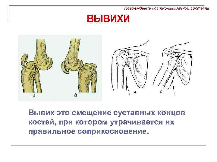 Повреждение костно-мышечной системы ВЫВИХИ Вывих это смещение суставных концов костей, при котором утрачивается их