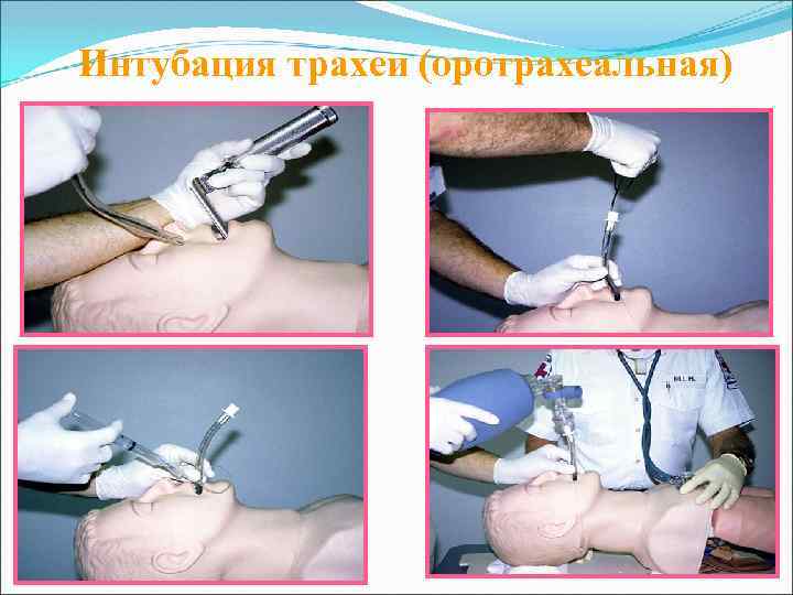 Интубация трахеи (оротрахеальная) 