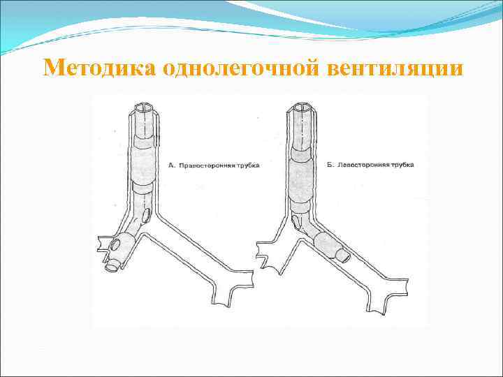 Методика однолегочной вентиляции 
