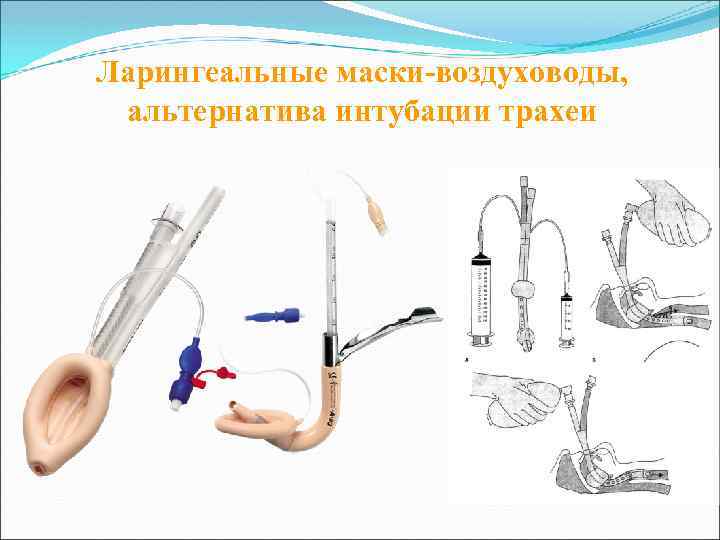 Ларингеальные маски-воздуховоды, альтернатива интубации трахеи 