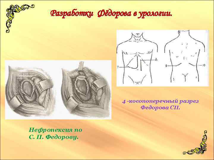 Разработки Фёдорова в урологии. 4 -косопоперечный разрез Федорова СП. Нефропексия по С. П. Федорову.