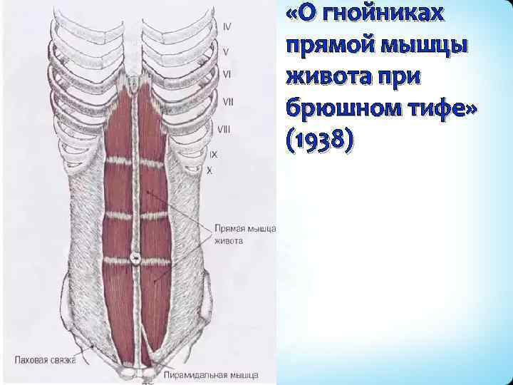  «О гнойниках прямой мышцы живота при брюшном тифе» (1938) 