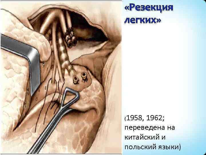  «Резекция легких» (1958, 1962; переведена на китайский и польский языки) 