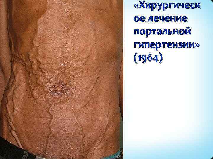  «Хирургическ ое лечение портальной гипертензии» (1964) 