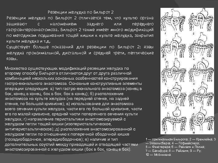 Резекции желудка по Бильрот 2 отличается тем, что культю органа зашивают с наложением заднего