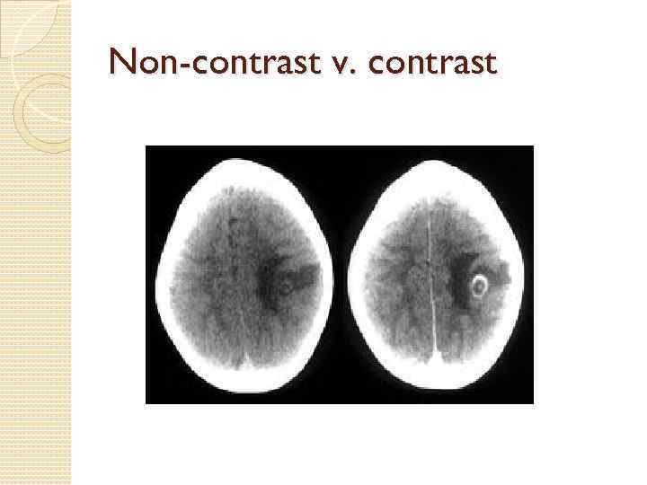 Non-contrast v. contrast 
