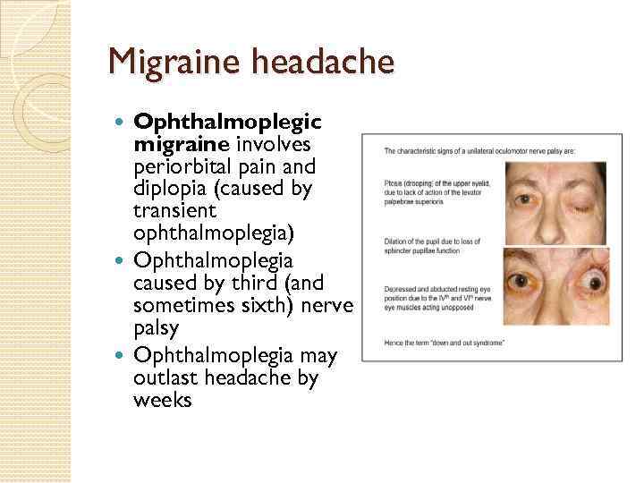 Diagnosis Of Ophthalmoplegic Migraine