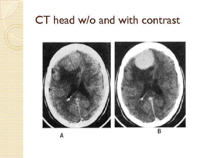 CT head w/o and with contrast 