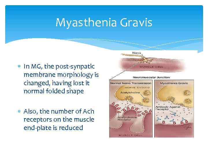 Myasthenia Gravis In MG, the post-synpatic membrane morphology is changed, having lost it normal