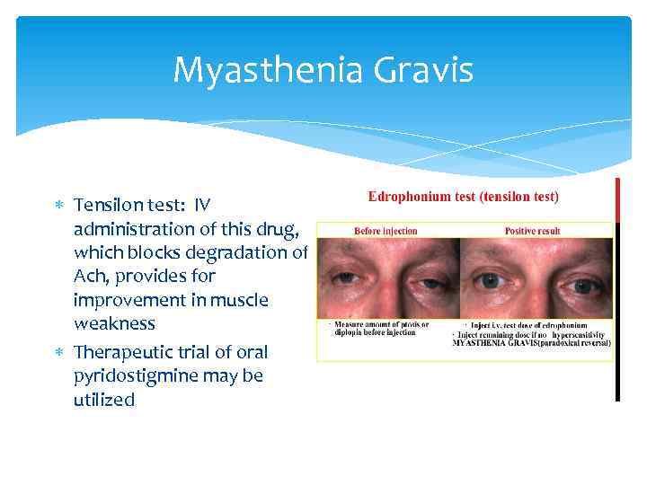 Myasthenia Gravis Tensilon test: IV administration of this drug, which blocks degradation of Ach,