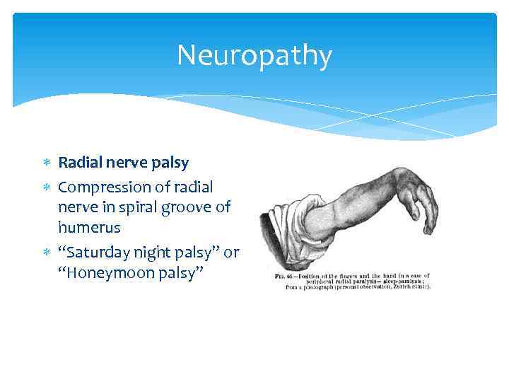 Neuropathy Radial nerve palsy Compression of radial nerve in spiral groove of humerus “Saturday