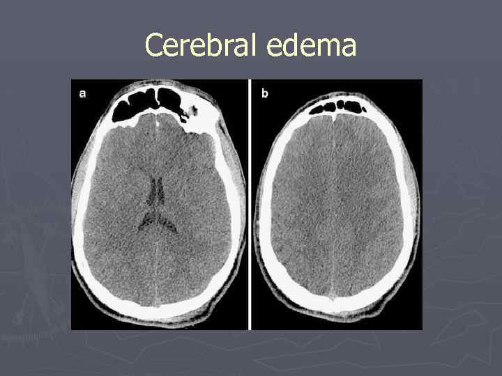 Cerebral edema 