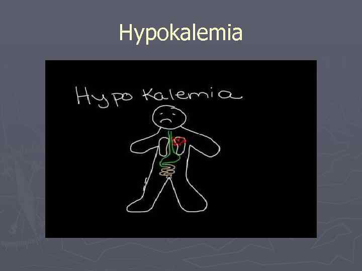 Hypokalemia 