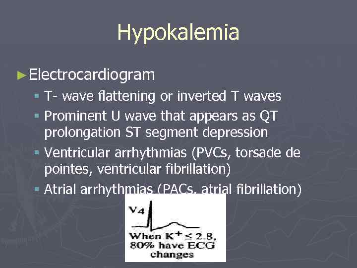 Hypokalemia ► Electrocardiogram § T- wave flattening or inverted T waves § Prominent U