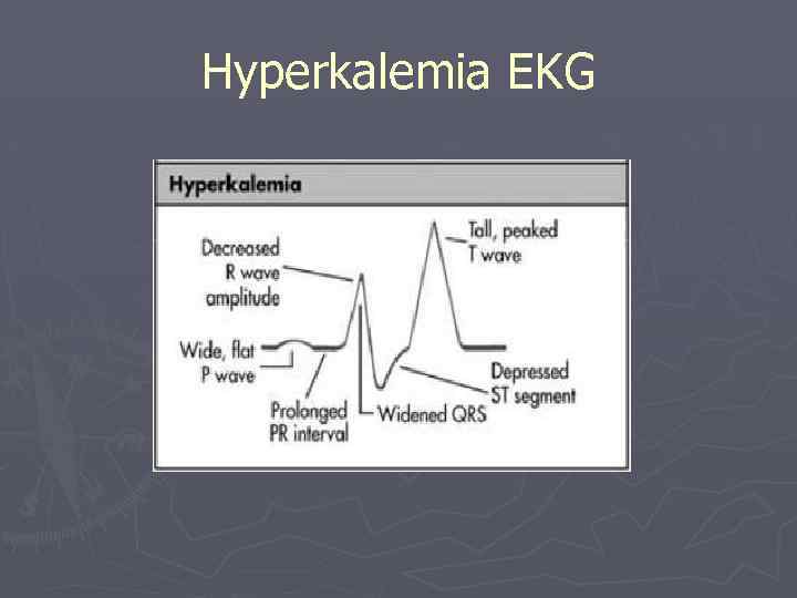 Hyperkalemia EKG 