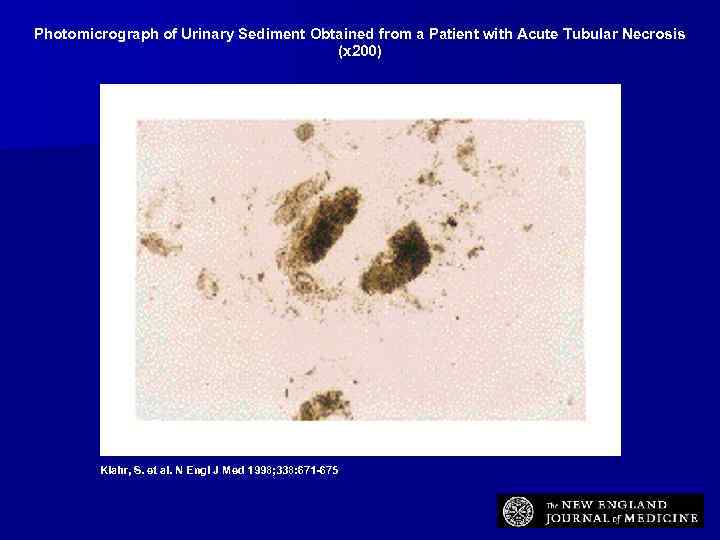 Photomicrograph of Urinary Sediment Obtained from a Patient with Acute Tubular Necrosis (x 200)