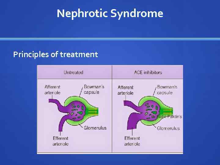 Nephrotic Syndrome Principles of treatment 