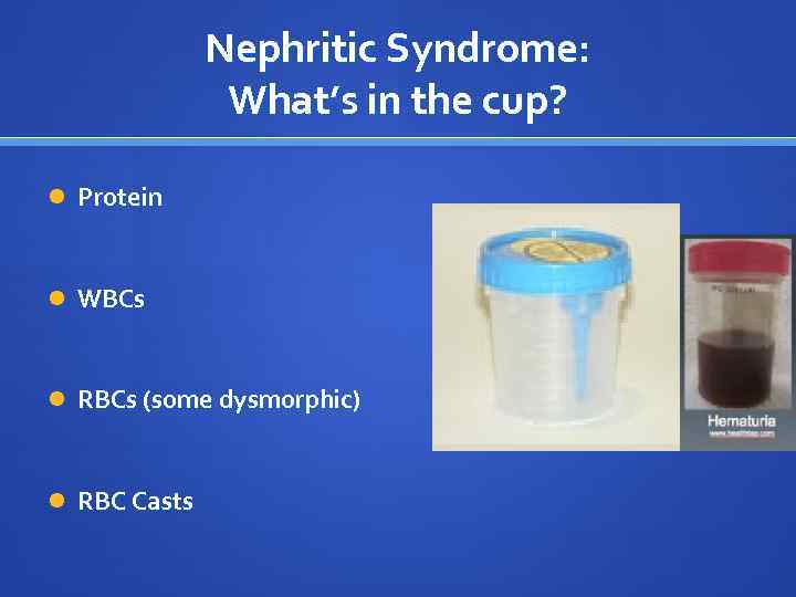 Nephritic Syndrome: What’s in the cup? Protein WBCs RBCs (some dysmorphic) RBC Casts 