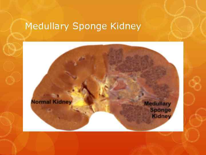 Medullary Sponge Kidney 
