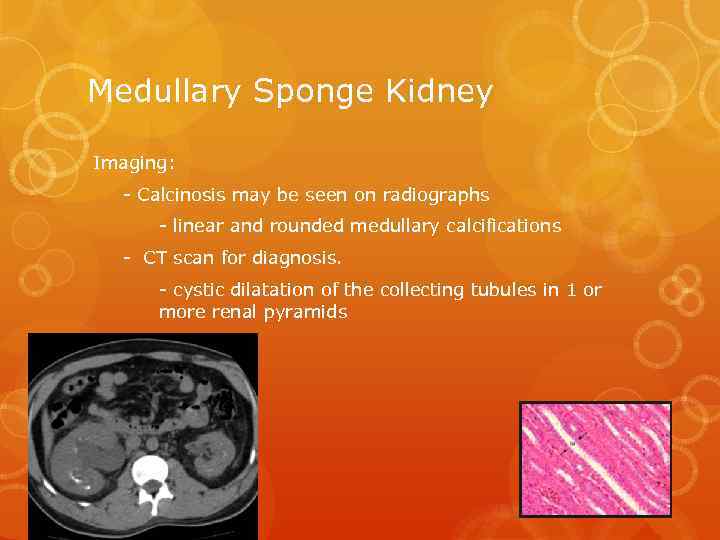 Medullary Sponge Kidney Imaging: - Calcinosis may be seen on radiographs - linear and