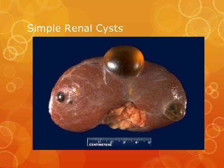 Simple Renal Cysts 
