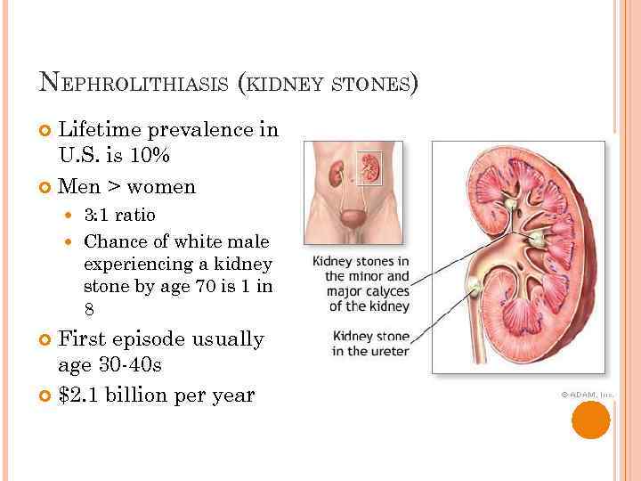 NEPHROLITHIASIS (KIDNEY STONES) Lifetime prevalence in U. S. is 10% Men > women 3: