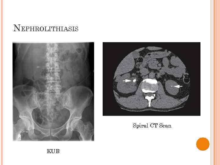 NEPHROLITHIASIS Spiral CT Scan KUB 