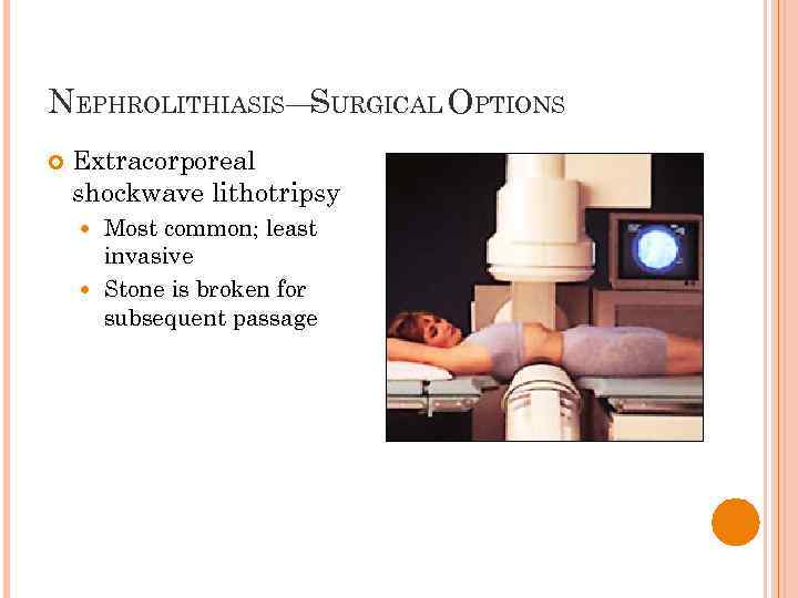 NEPHROLITHIASIS— URGICAL OPTIONS S Extracorporeal shockwave lithotripsy Most common; least invasive Stone is broken