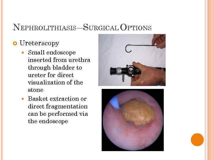 NEPHROLITHIASIS— URGICAL OPTIONS S Ureterscopy Small endoscope inserted from urethra through bladder to ureter