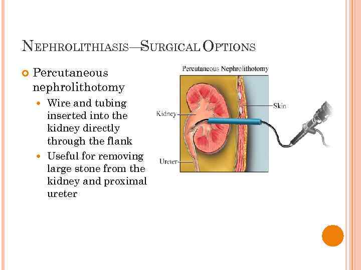 NEPHROLITHIASIS— URGICAL OPTIONS S Percutaneous nephrolithotomy Wire and tubing inserted into the kidney directly