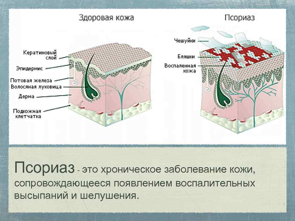 Псориаз - это хроническое заболевание кожи, сопровождающееся появлением воспалительных высыпаний и шелушения. 