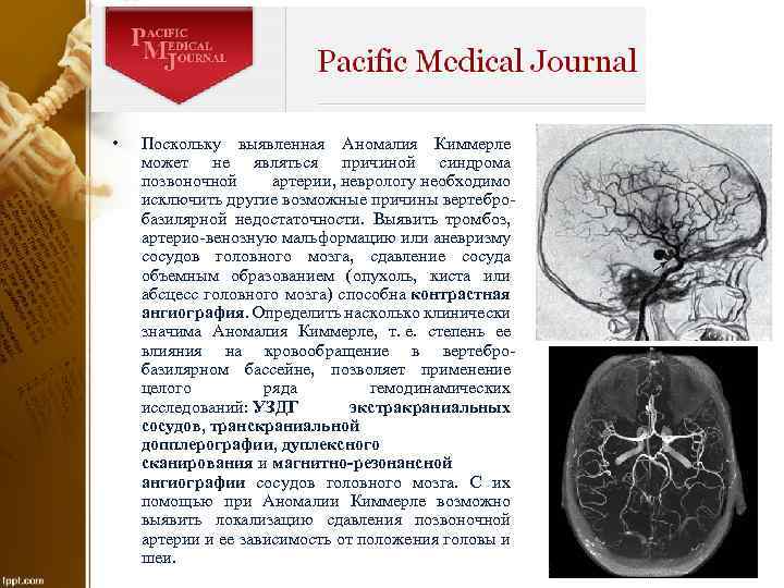  • Поскольку выявленная Аномалия Киммерле может не являться причиной синдрома позвоночной артерии, неврологу