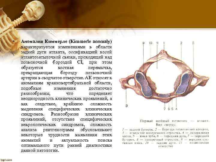  • Аномалия Киммерле (Kimmerle anomaly) характеризуется изменениями в области задней дуги атланта, оссификацией