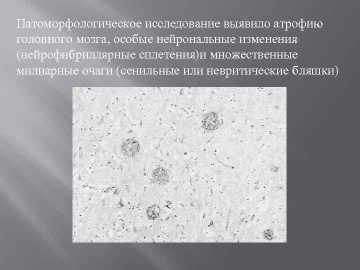 Патоморфологическое исследование выявило атрофию головного мозга, особые нейрональные изменения (нейрофибриллярные сплетения)и множественные милиарные очаги