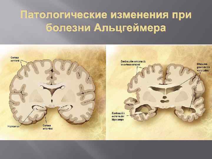 Патологические изменения при болезни Альцгеймера 