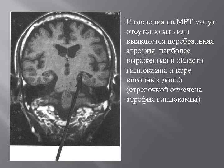 Изменения на МРТ могут отсутствовать или выявляется церебральная атрофия, наиболее выраженная в области гиппокампа