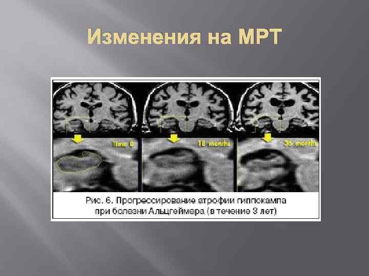 Изменения на МРТ 