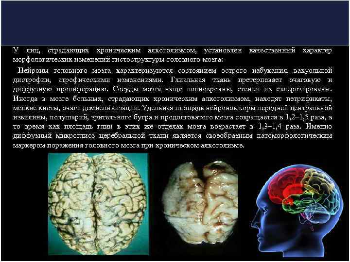 У лиц, страдающих хроническим алкоголизмом, установлен качественный характер морфологических изменений гистоструктуры головного мозга: Нейроны