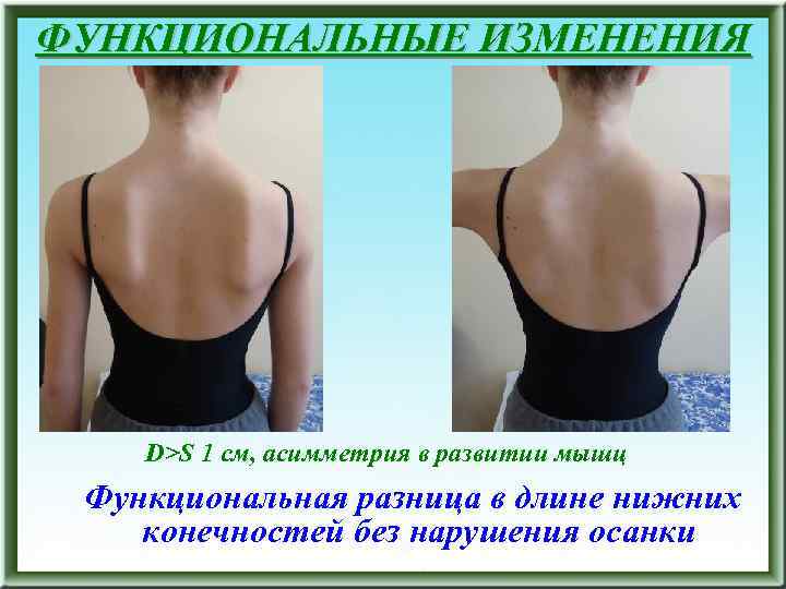 ФУНКЦИОНАЛЬНЫЕ ИЗМЕНЕНИЯ D>S 1 см, асимметрия в развитии мышц Функциональная разница в длине нижних