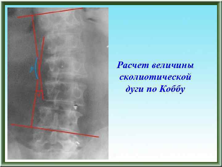 Расчет величины сколиотической дуги по Коббу 