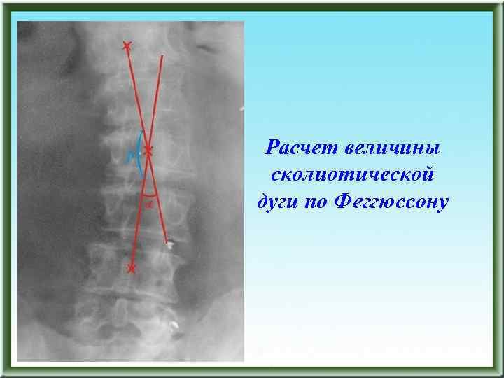 Расчет величины сколиотической дуги по Феггюссону 