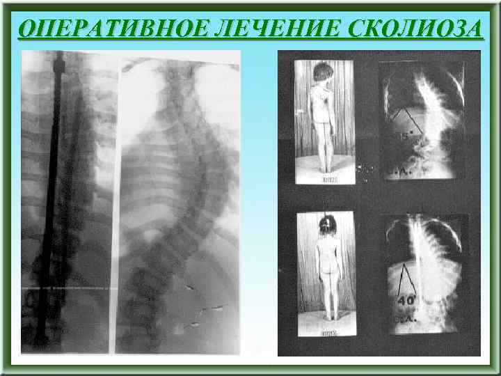 ОПЕРАТИВНОЕ ЛЕЧЕНИЕ СКОЛИОЗА 