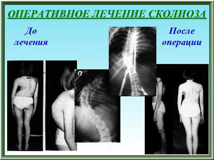 ОПЕРАТИВНОЕ ЛЕЧЕНИЕ СКОЛИОЗА До лечения После операции 