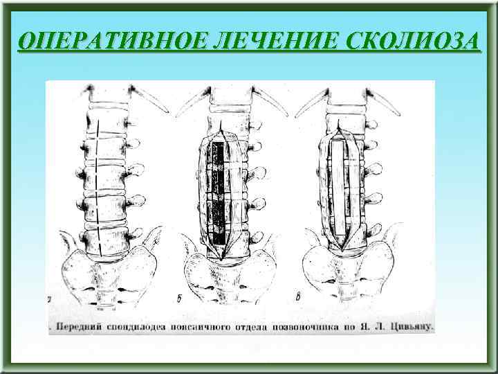 ОПЕРАТИВНОЕ ЛЕЧЕНИЕ СКОЛИОЗА 